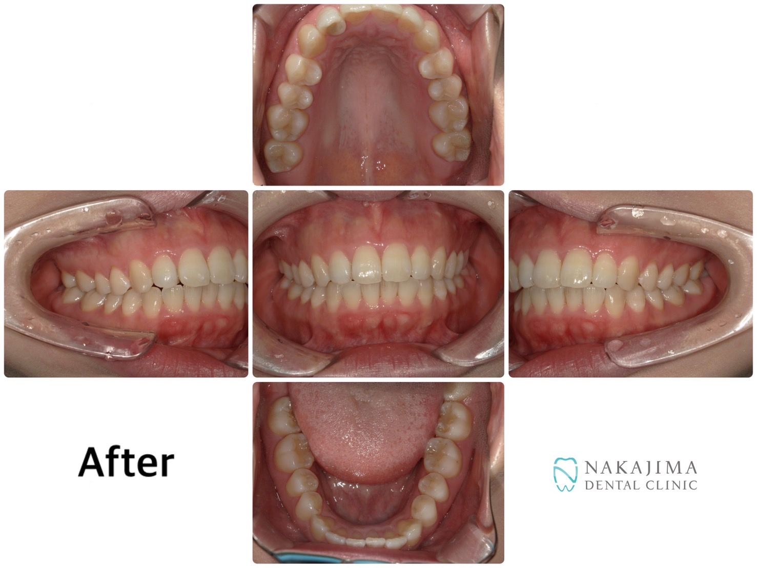 歯列矯正ビフォーアフター