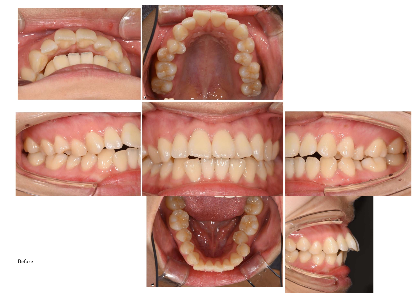 矯正治療　Before