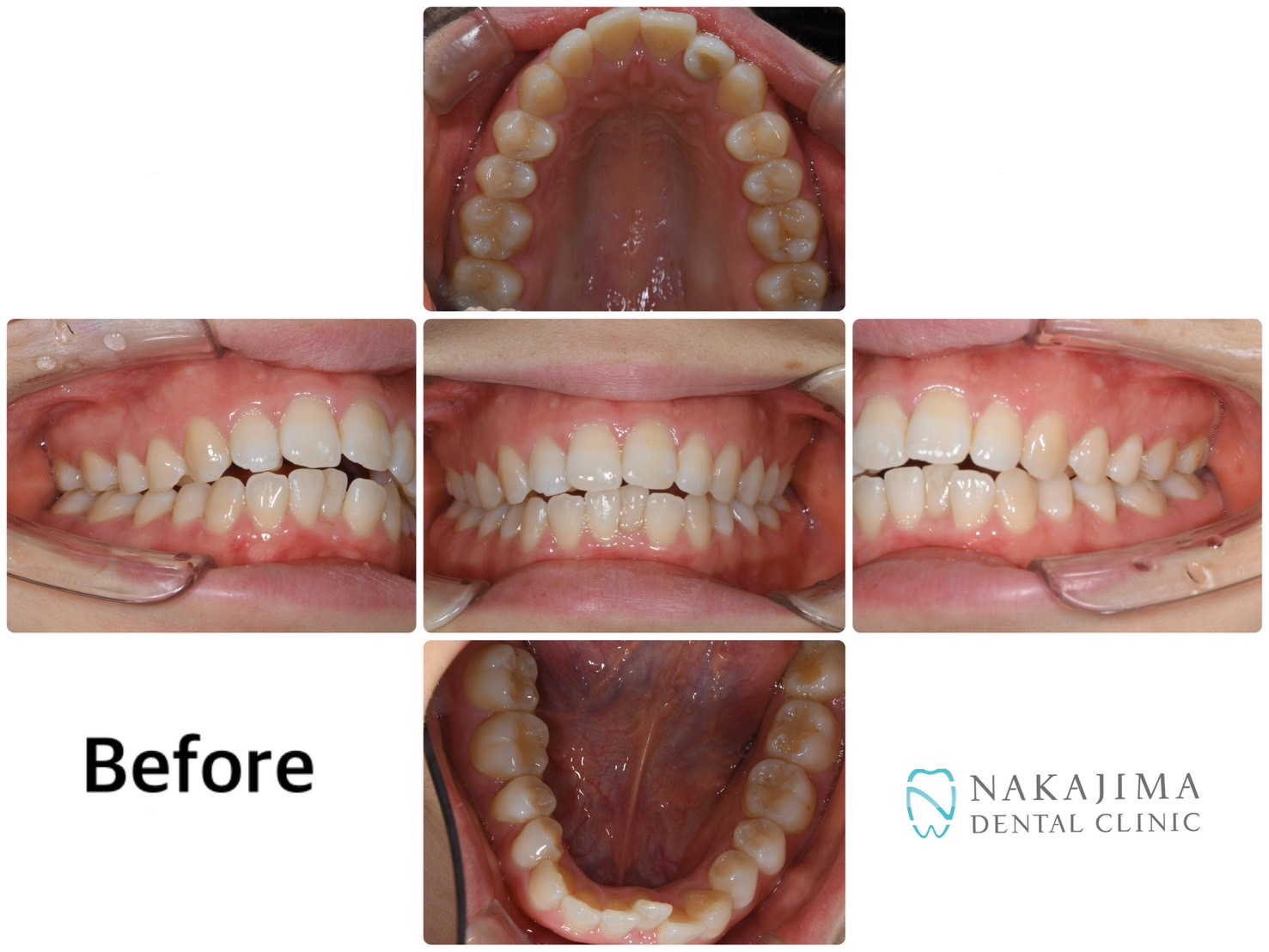 歯列矯正ビフォーアフタオー